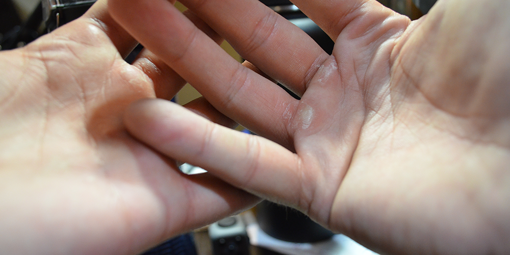 Building blisters: six weeks of personal training